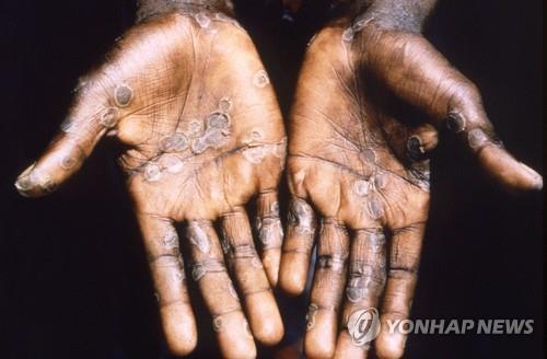 몽키팍스  감염자의 손바닥